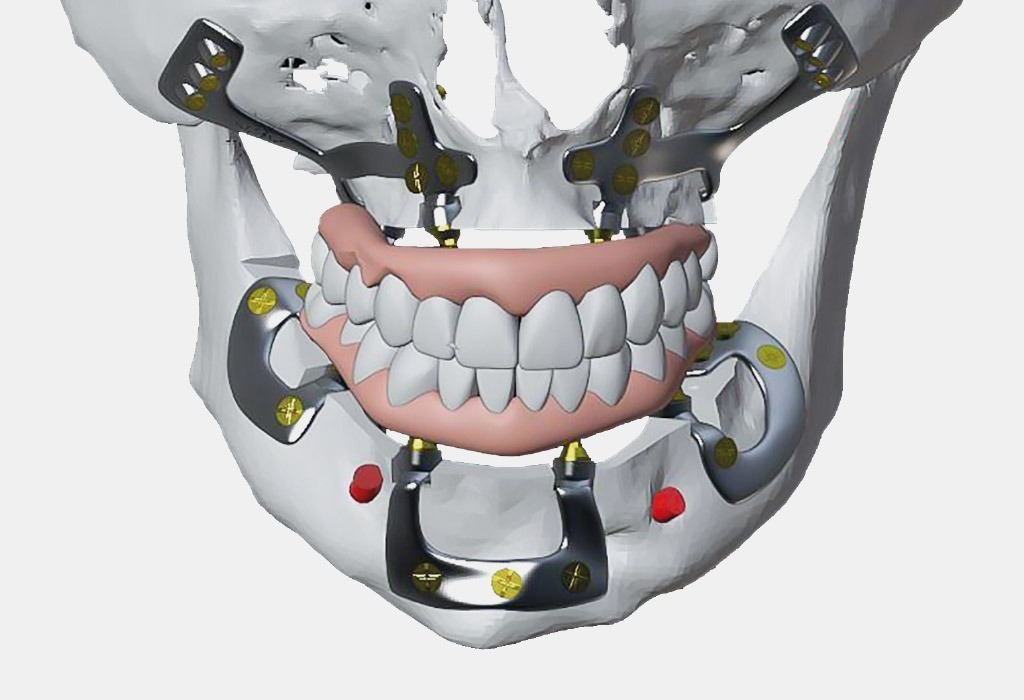implantes subperiósticos para pacientes sin hueso
