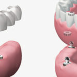 implantes dentales en Terrassa