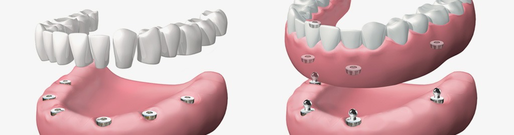 Implantes dentales en Terrassa