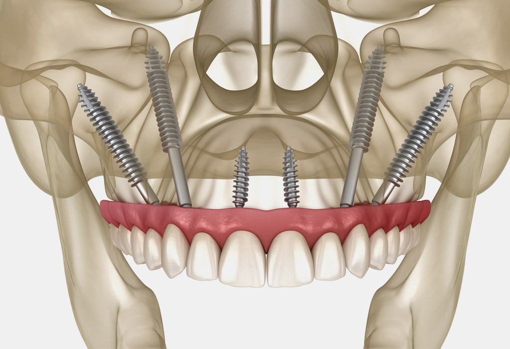 implantes zigomáticos para personas con poco hueso