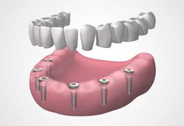 tratamiento completo en 1 visita dentadura fija completa