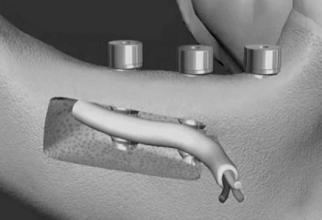 Soluciones dentales para personas con poco hueso en Terrassa