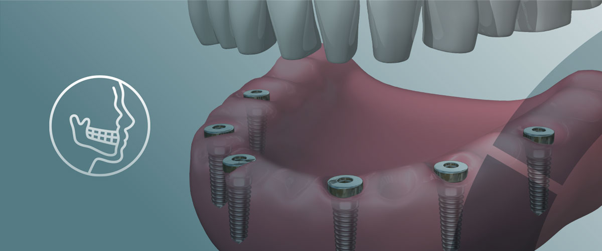 cirugía maxilofacial: dientes fijos en 1 día en Terrassa cirugía maxilofacial: dientes fijos en 1 día en Terrassa