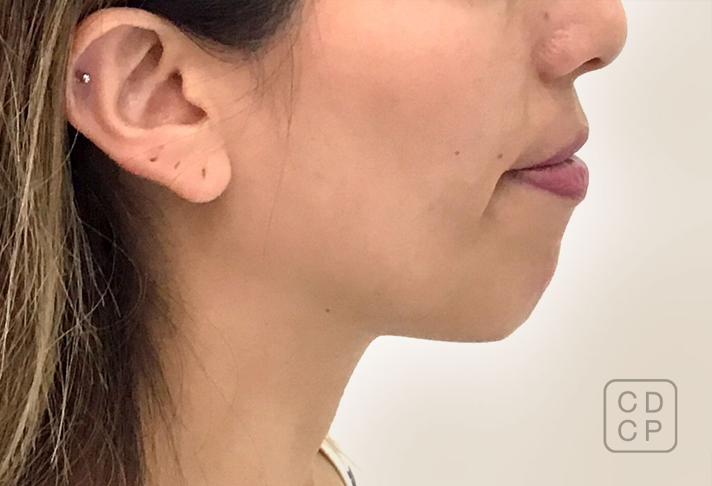cirugía maxilofacial: ortognática en Terrassa