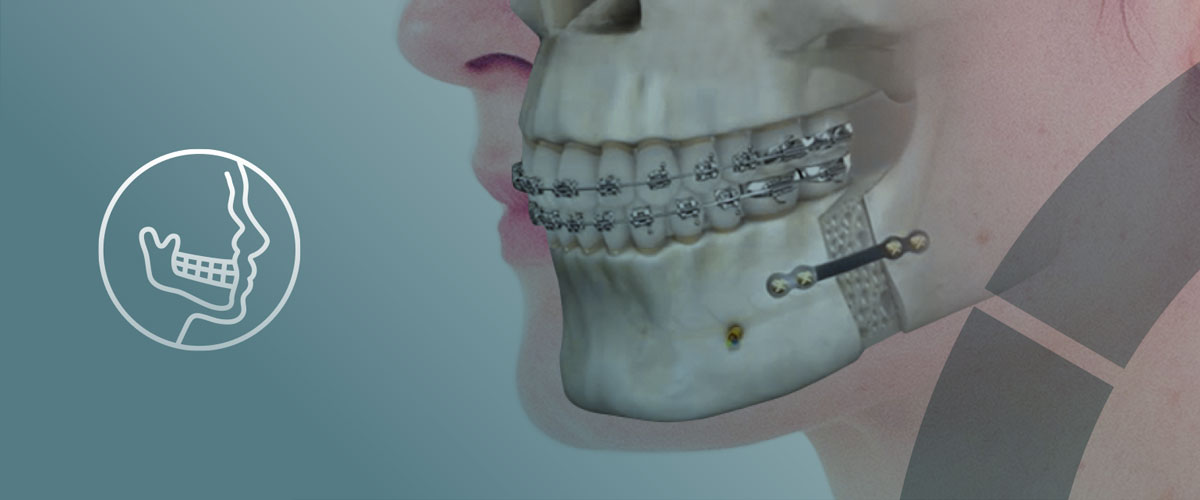 cirugía maxilofacial: ortognática en Terrassa