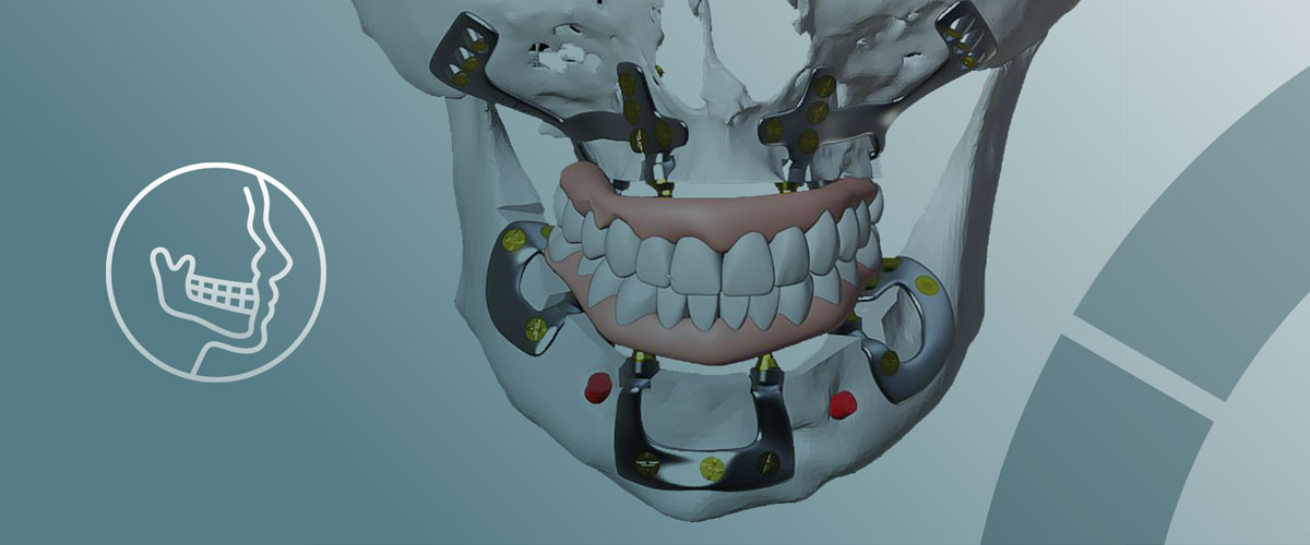 cirugía maxilofacial: implantes subperiósticos en Terrassa cirugía maxilofacial: implantes subperiósticos en Terrassa
