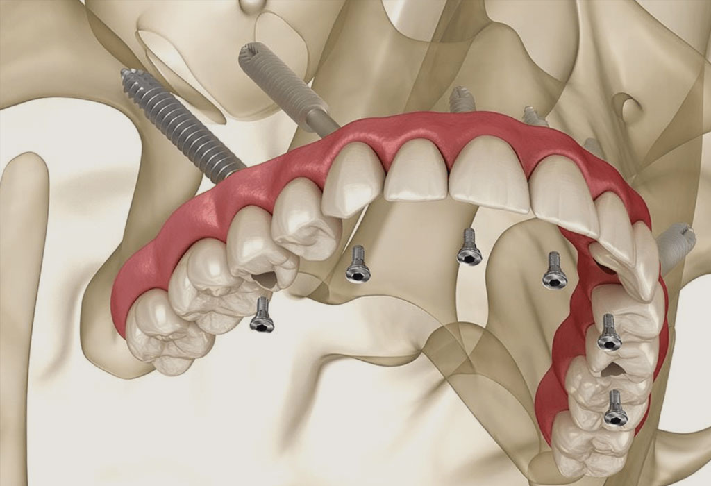 implantes zigomáticos para personas con poco hueso implantes zigomáticos para personas con poco hueso