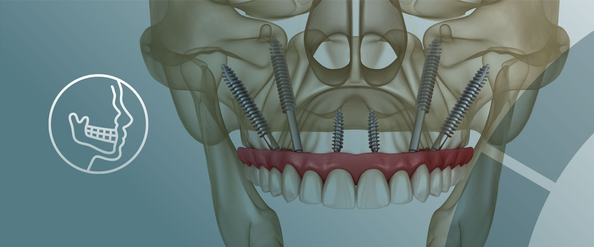 cirugía maxilofacial: implantes zigomáticos en Terrassa cirugía maxilofacial: implantes zigomáticos en Terrassa