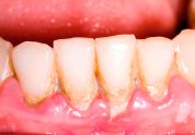 periodoncia en Terrassa