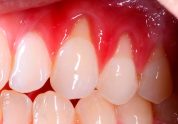 periodoncia en Terrassa