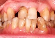 periodoncia en Terrassa