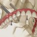 no tengo hueso para implantes dentales