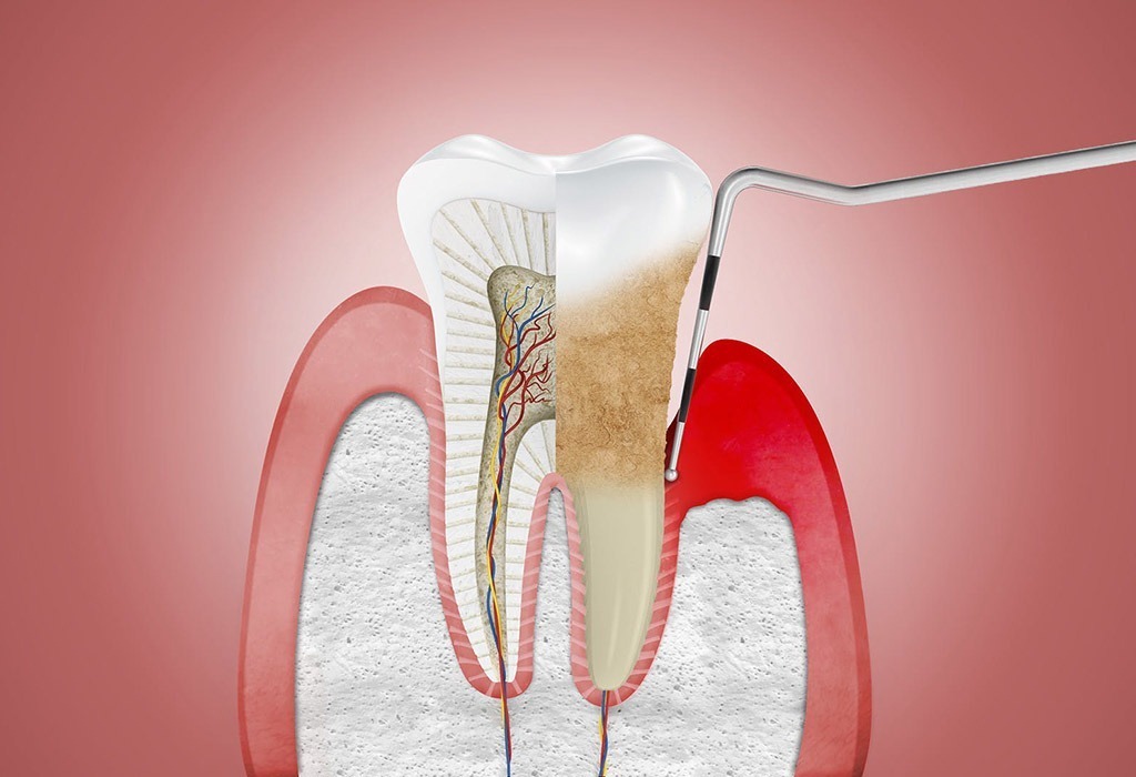 sondaje de periodoncia