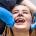 Urgencia dental con brackets
