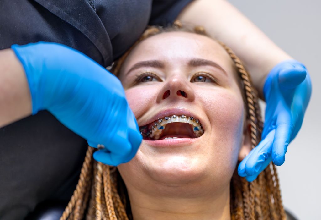 Urgencia dental con brackets: Guía completa de soluciones rápidas y efectivas